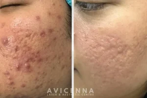 Avicenna Laser & Aesthetic Centre [Pigmentation, Acne, Acne Scar, Hair Loss, Slimming, Laser]
