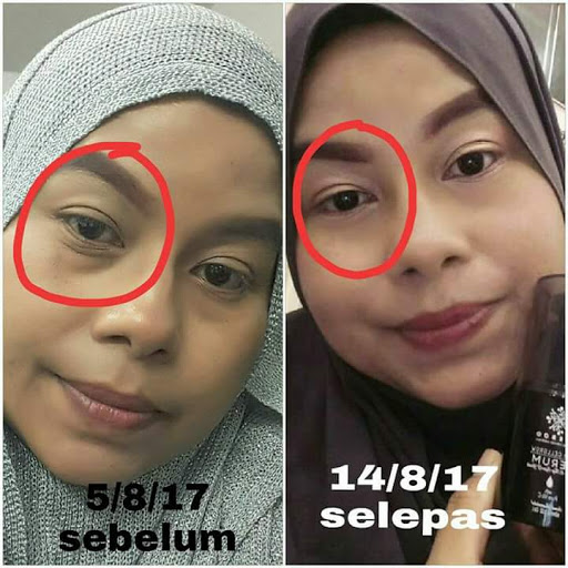 RAWATAN DERMAPEN UNTUK PARUT DAN FACIAL WAJAH