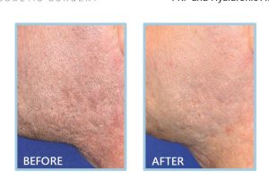 O2 Klinik (Mount Austin) | Acne Scar Treatment | Pigmentation Treatment | 瘦身服务