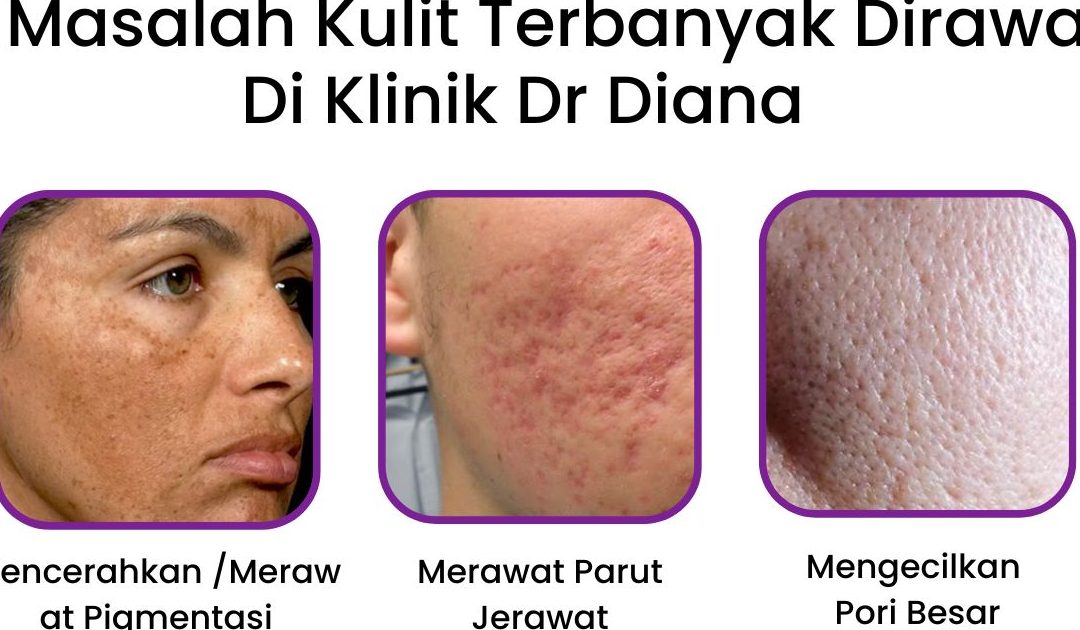 pico laser di chukai malaysia rawatan terkini untuk masalah kulit