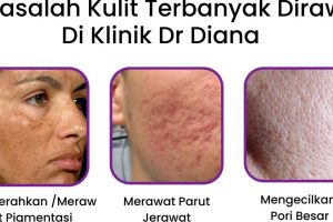Pico Laser di Parit Buntar, Malaysia: Rawatan Kulit Inovatif untuk Masalah Pigmentasi dan Lain-Lain