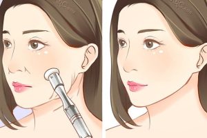 Rawatan Pico Laser di Kulim, Malaysia: Faedah, Harga & Klinik Terbaik